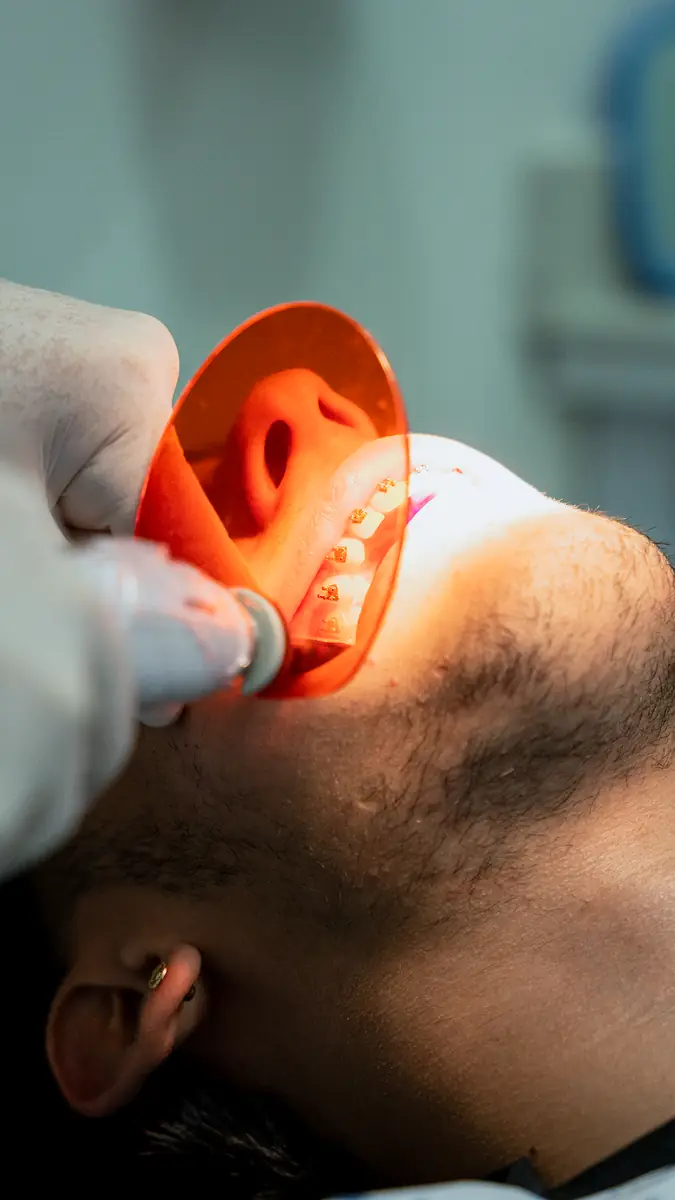 Tratamiento de ortodoncia con lámpara de fotocurado